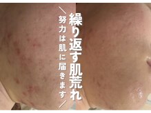 ホワイトアクア 鹿児島店(WHITE AQUA)/ハーブピーリング3ヶ月の変化