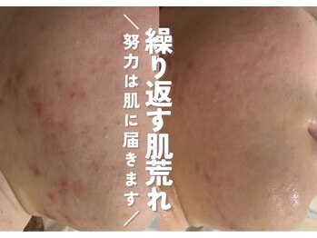 ホワイトアクア 鹿児島店(WHITE AQUA)/ハーブピーリング3ヶ月の変化