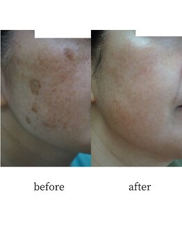 アップルミント/＜フェイシャル＞before・after