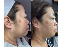 ラニー アンド ココネイル(LANIE&CocoNail)/脂肪分解　レモンボトル