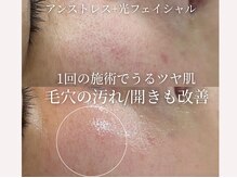 芸能人御用達人気のアンストレス♪で一気にうるツヤ肌に！