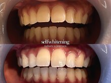 ココロビューティーギャラリー 武蔵小杉(cocorobeauty gallery)/セルフホワイトニング★4照射