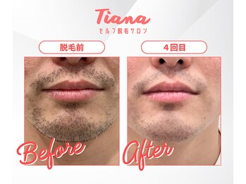 ティアナ 秋田大館店(Tiana)/髭脱毛　Before＆After