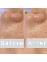 リンダ 西宮店(LINDA)/ハイドロ×プラズマ