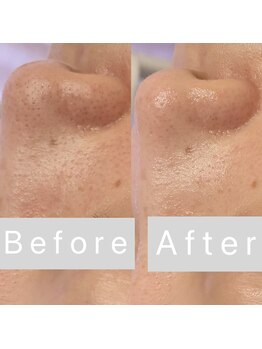 リンダ 西宮店(LINDA)/ハイドロ×プラズマ