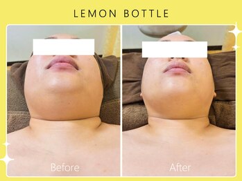 シロカネ 光の森店(SHIROKANE)/レモンボトル×小顔コルギ☆