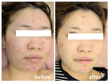 ラミーユ(La Miu)/1度の施術で美白肌