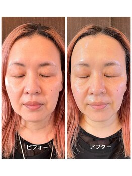 メイクアップスタジオ ウィッシュ(Make up Studio Wish!)の写真/たるみ毛穴もフェイスラインのもたつきも最先端はり美容で解決!韓国で大人気のDNAピール九州初上陸!