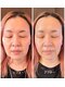メイクアップスタジオ ウィッシュ(Make up Studio Wish!)の写真/たるみ毛穴もフェイスラインのもたつきも最先端はり美容で解決!韓国で大人気のDNAピール九州初上陸!