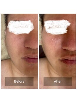 ラビ(RABBI)/30代男性　小顔矯正EMS 