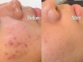 ベルドア(Bell Door)/プラズマフェイシャル