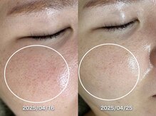 サロンドジェシカ(salon de Jessica)/プラズマ＋美肌フォト