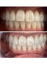 コントレール 歯ぁと(CONTRAIL)/ビフォーアフター