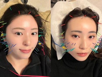 アム(aM)の写真/お顔のむくみ・フェイスラインのもたつきが気になる。そんな方はぜひ"aMの美容鍼"をご体感ください。