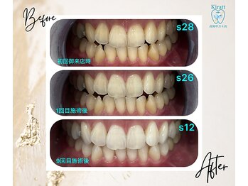キラット 高知中万々店(Kiratt)/【クリスタルホワイトニング】