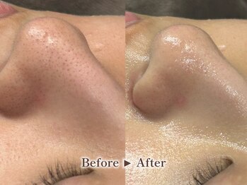 リテルナ(Re.terna)/■毛穴洗浄・毛穴ケアコース