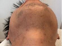 オアシスラグーン(OASIS LAGOON)/メンズ脱毛（症例２：after）