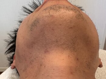 オアシスラグーン(OASIS LAGOON)/メンズ脱毛(症例2:after)