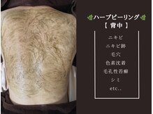 アイル 博多祇園店(iru)/大人気の背中ハーブピーリング