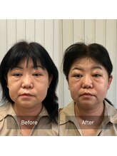 ナギ鍼灸院(nagi鍼灸院)/美容鍼　40代女性