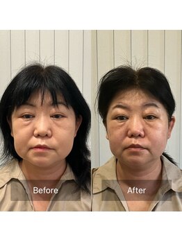 ナギ鍼灸院(nagi鍼灸院)/美容鍼　40代女性