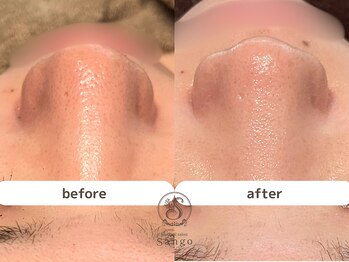 サンゴ(Sango)/約3ヶ月 毛穴の開き/くすみ改善