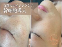 40代～おすすめ奇跡のエイジングケア！シミ/しわケア/幹細胞導入