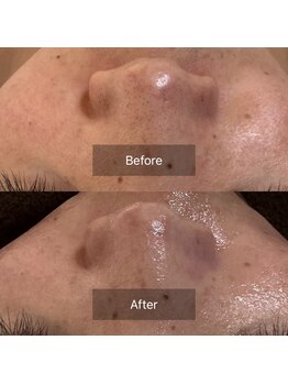 エヌ(enu)/毛穴洗浄/炭酸ガスパック