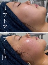 ザ ピーチ(THE PEACH)/オンダリフトの即効性