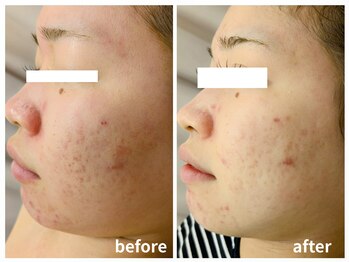 ラミーユ(La Miu)/くすみ・むくみスッキリ♪