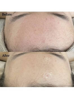 ミセル(MISEL2nd)/ニキビケア/肌質改善もお任せ♪