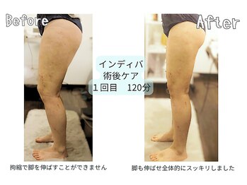 カリド ラボ(CALIDO LAB)/インディバ　術後ケア