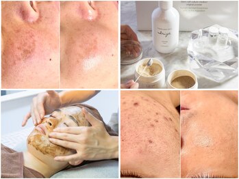 サロン ツムギ たまプラーザ店(SALON TSUMUGI)の写真/【本気の肌質改善！】エクソソームハーブ 再生美容 ♪毛穴 ニキビなどに剥けない ハーブでお悩みを解消◎