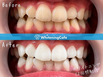 ホワイトニングカフェ 天王寺あべの店(WhiteningCafe)の写真