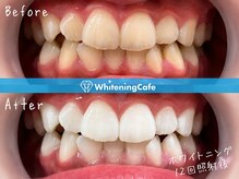 ホワイトニングカフェ 天王寺あべの店(WhiteningCafe)
