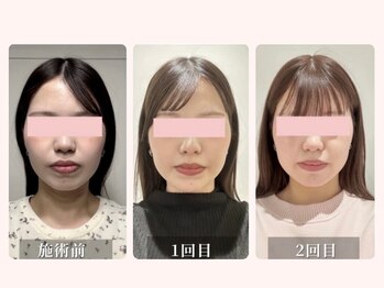 シー 下北沢(sea)の写真/《喜びの声続々》骨格/筋肉/筋膜/リンパから整える本格小顔矯正◆バランス調整&血液循環促進でお悩み解消！