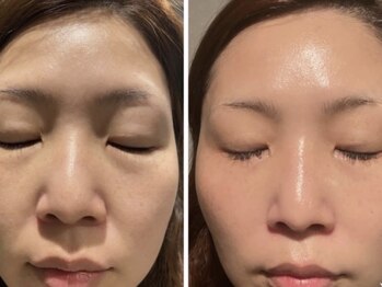 ミルジュ(MiLuJu)/マーメイドセルトリートメント