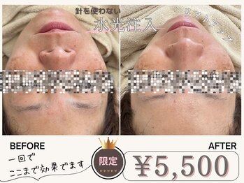 マヴィ 香里園店(MavY.)/ノンニードル水光注入☆