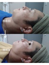 メルシー レディースアンドメンズサロン(Merci)/メンズのシミケアできます。