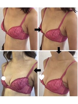 ギフト 浦和(GIFT)/バストアップ症例