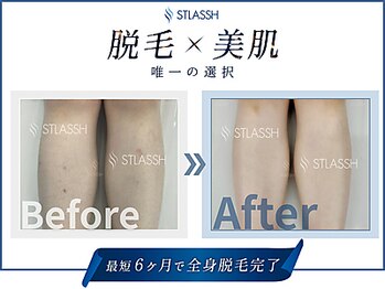 ストラッシュ 池袋駅前店/メニュー：全身脱毛（足）