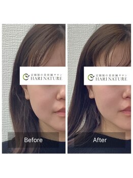 ハリナチュレ 西心斎橋店(HARINATURE)/Before After