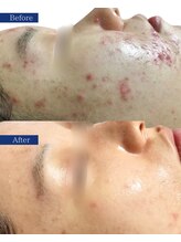 ビズビズ(bisebise)/メンズニキビ学割U24★大阪梅田