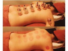 順蘭堂/背中ハイパーナイフ＋カッピング