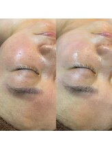 アロー(Allo!)/大人気ハーブピーリング