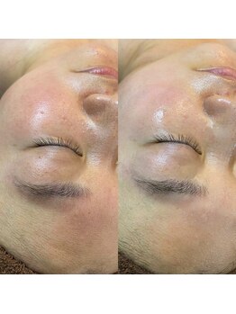 アロー(Allo!)/大人気ハーブピーリング