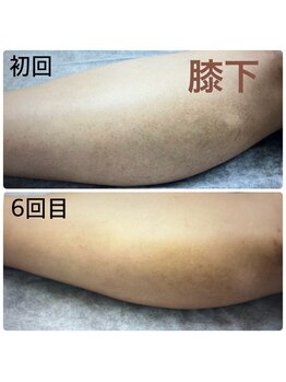 エヌアール(NR)/men's 膝下