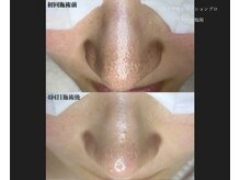 見て触って変化を実感エクストラクション×ララピール