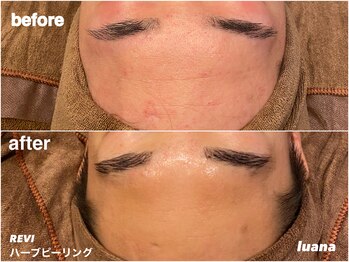 ルアナ(Luana)/【人気No.1】陶肌トリートメント