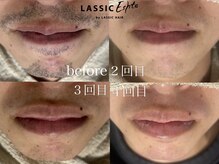 ラシックヘア 三木本店(LASSIC HAIR)/ヒゲ脱毛◇結果写真